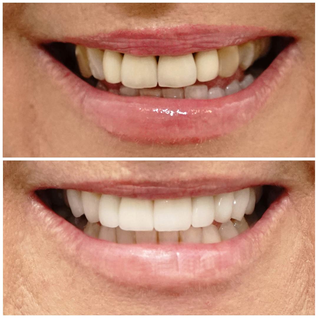 smiling-dental-porcelain-veneers-before-after-11